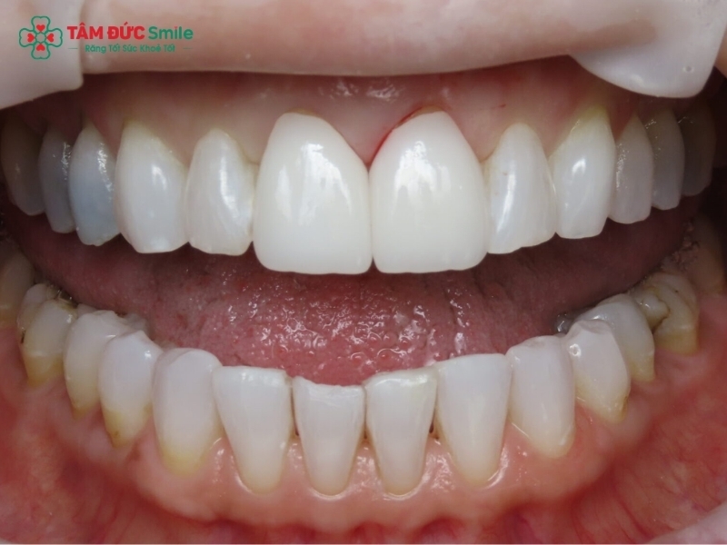Bọc răng sứ bị đen nướu: Nguyên nhân, dấu hiệu và cách khắc phục