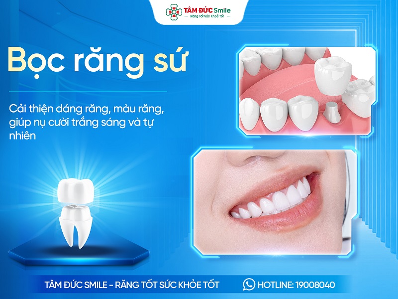 Bọc răng sứ - Kỹ thuật thuật phục hình răng sứ thẩm mỹ an toàn, không đau