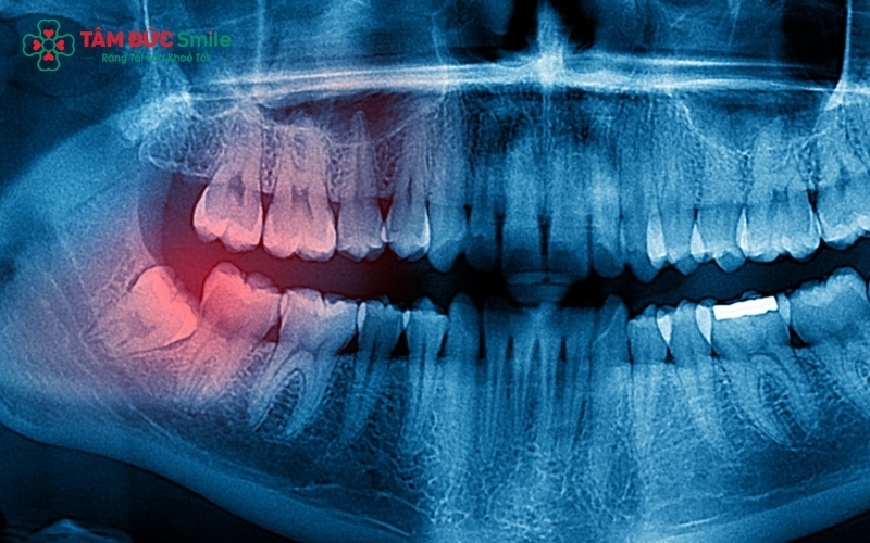 Răng khôn mọc lệch thường âm thầm gây hại cho răng số 7 kế cận và các mô nướu xung quanh.