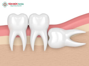 Các kiểu răng khôn mọc lệch phổ biến, biến chứng và cách xử lý răng khôn mọc lệch