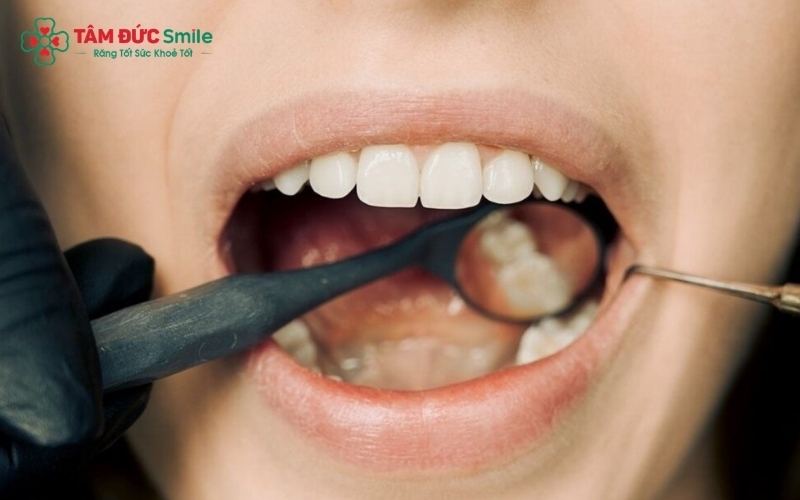 Các nguyên liệu tự nhiên như bạc hà hay chanh chỉ giúp che đậy mùi hôi tạm thời chứ không thể loại bỏ hoàn toàn vi khuẩn trong túi nha chu hay cao răng.