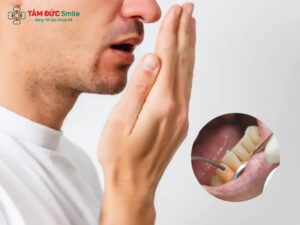 Hôi miệng nặng: Nguyên nhân, cách trị và phòng ngừa