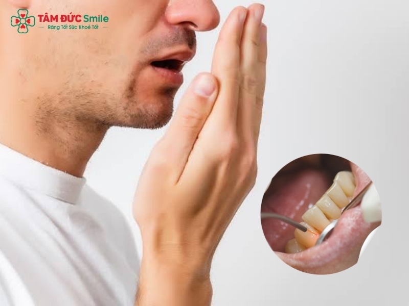 Hôi miệng nặng: Nguyên nhân, cách trị và phòng ngừa