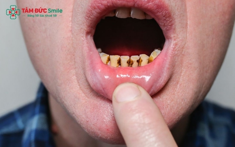 Các mẹo tại nhà không thể phục hồi phần mô đã mất, do đó việc đến nha khoa là cần thiết để xử lý triệt để.