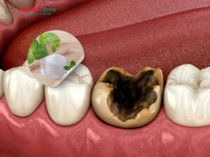 Cách trị sâu răng tại nhà phổ biến