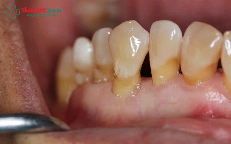 Viêm nướu nếu không được điều trị kịp thời sẽ tiến triển thành viêm nha chu, gây tiêu xương và dẫn đến nguy cơ lung lay, mất răng.