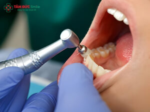Cách trị viêm nướu răng an toàn, hiệu quả