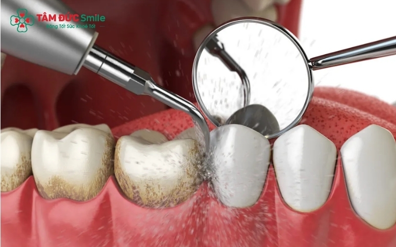 Thăm khám định kỳ và vệ sinh răng miệng chuyên nghiệp tại nha khoa giúp duy trì mô nướu khỏe mạnh và ngăn ngừa bệnh lý tái phát.