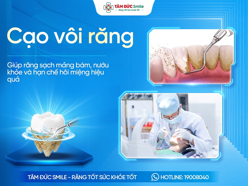 Cạo vôi răng ( lấy cao răng) là gì? Quy trình, Chi phí và Lưu ý chăm sóc