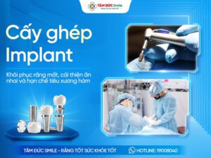 Cấy ghép Implant là gì? Ưu điểm, Quy trình, Chi phí và Địa chỉ uy tín