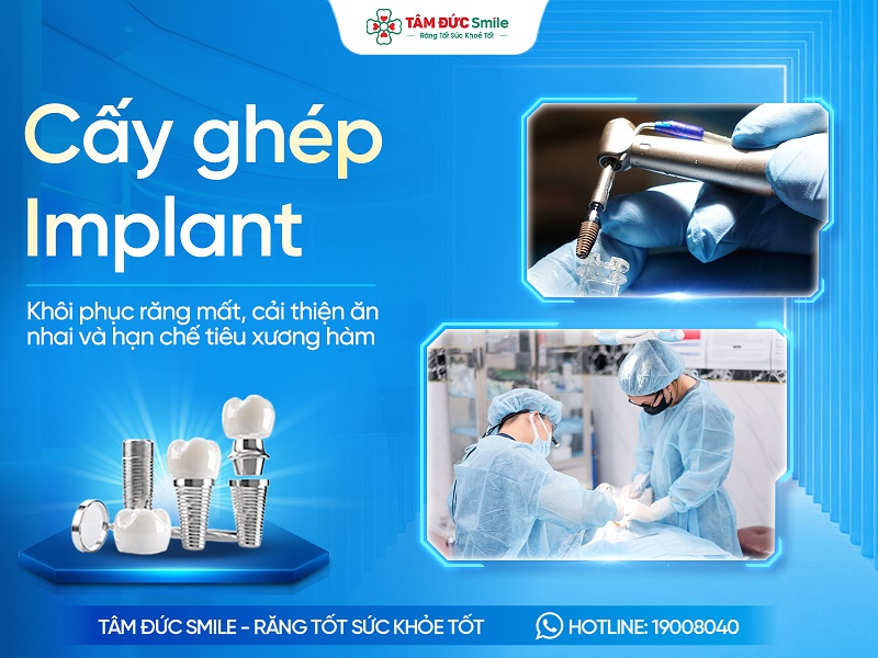 Cấy ghép Implant là gì? Ưu điểm, Quy trình, Chi phí và Địa chỉ uy tín