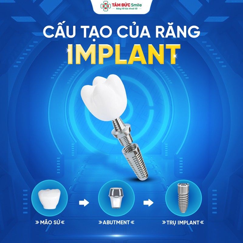 Răng Implant hoàn chỉnh gồm trụ Implant, khớp nối Abutment và mão răng sứ