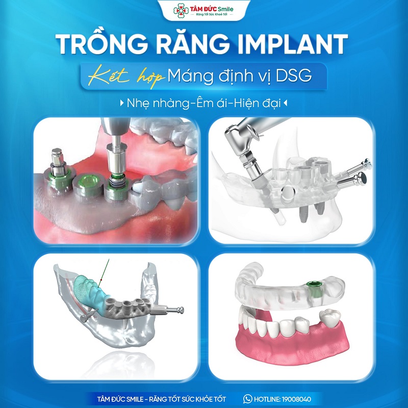 cay-ghep-implant-6