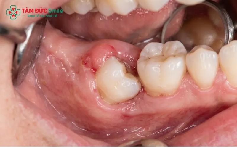 Răng khôn mọc lệch đâm vào răng số 7 là chỉ định nhổ răng phổ biến để bảo vệ chiếc răng ăn nhai quan trọng.