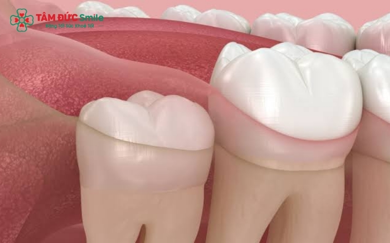 Nếu răng khôn mọc thẳng, không gây biến chứng và dễ dàng vệ sinh, bạn hoàn toàn có thể cân nhắc giữ lại.