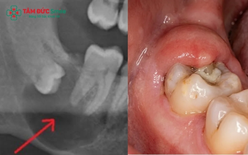 Trì hoãn nhổ răng khôn mọc lệch có thể dẫn đến viêm lợi trùm, sâu răng số 7 và nhiều biến chứng khó lường.