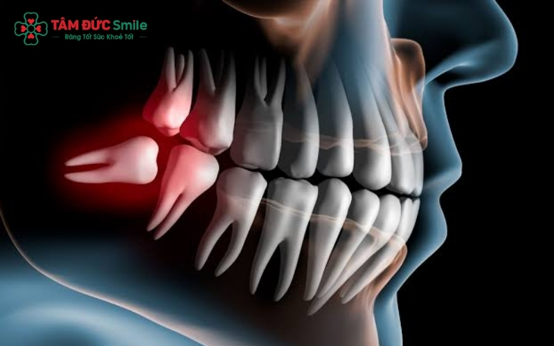 Việc quyết định giữ hay nhổ răng số 8 cần dựa trên phim chụp X-quang để đánh giá hướng mọc và mức độ ảnh hưởng đến các răng lân cận.