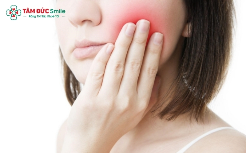 Răng khôn mọc lệch tạo điểm mù khó vệ sinh, là 'thủ phạm' gây sâu răng số 7 và viêm lợi trùm kéo dài.