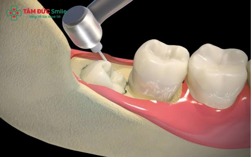 Tại Nha khoa Tâm Đức Smile, công nghệ CT Cone Beam 3D giúp bác sĩ kiểm soát chính xác vị trí chân răng, đảm bảo quá trình nhổ răng an toàn và hạn chế tối đa rủi ro.