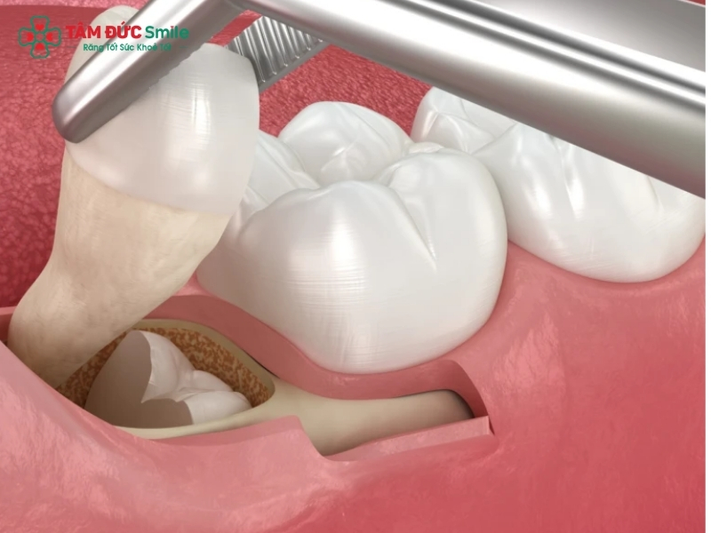 Có nên nhổ răng số 8? Quy trình nhổ răng số 8 tại Nha khoa