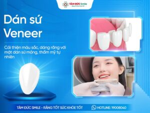 Dán sứ Veneer là gì? Quy trình, Ưu nhược điểm, Chi phí và Đối tượng phù hợp