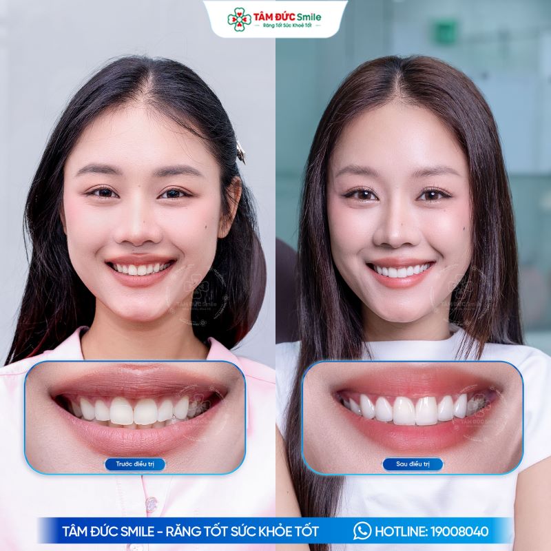 Dán sứ Veneer cải thiện màu sắc và hình thể răng, đồng thời hạn chế mài răng khi được chỉ định đúng