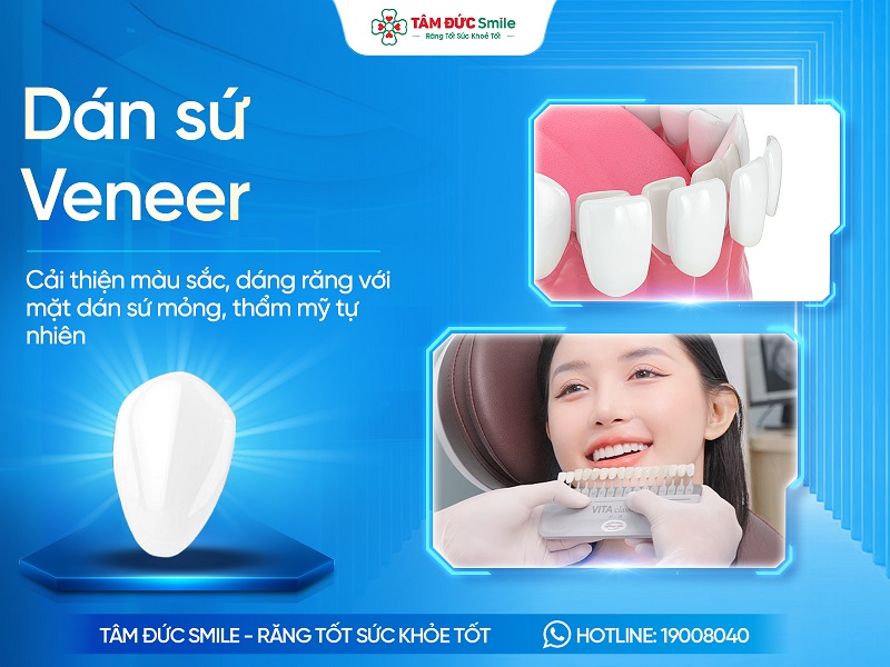 Dán sứ Veneer là gì? Quy trình, Ưu nhược điểm, Chi phí và Đối tượng phù hợp