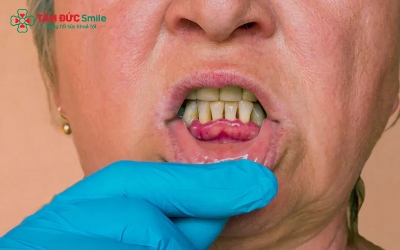 Các dấu hiệu viêm nha chu sớm, nướu chuyển sang màu đỏ thẫm, sưng nề và dễ chảy máu khi đánh răng.