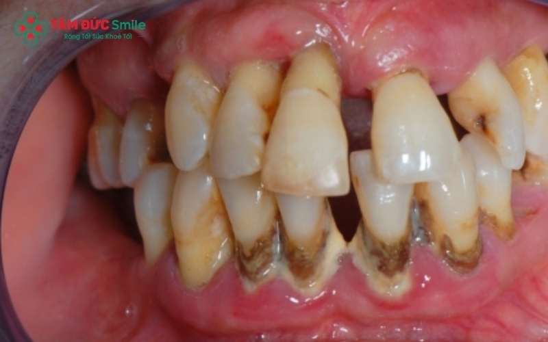 Cao răng tích tụ lâu ngày là "ổ chứa" vi khuẩn chính gây ra bệnh viêm nha chu.