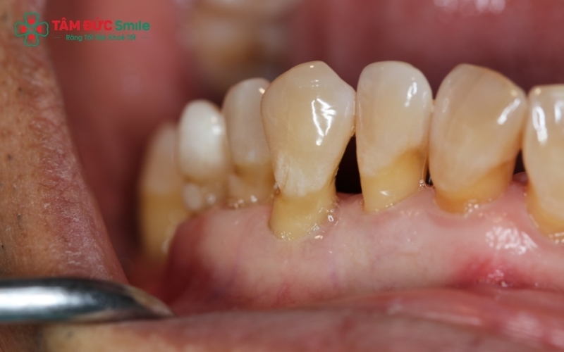 Viêm nha chu không được kiểm soát sẽ dẫn đến túi nha chu sâu, tiêu xương và nguy cơ mất răng thật.