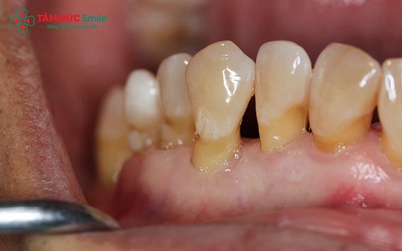Mảng bám và vôi răng là "thủ phạm" thầm lặng khiến nướu sưng đỏ, đau nhức mà bạn không nên bỏ qua.