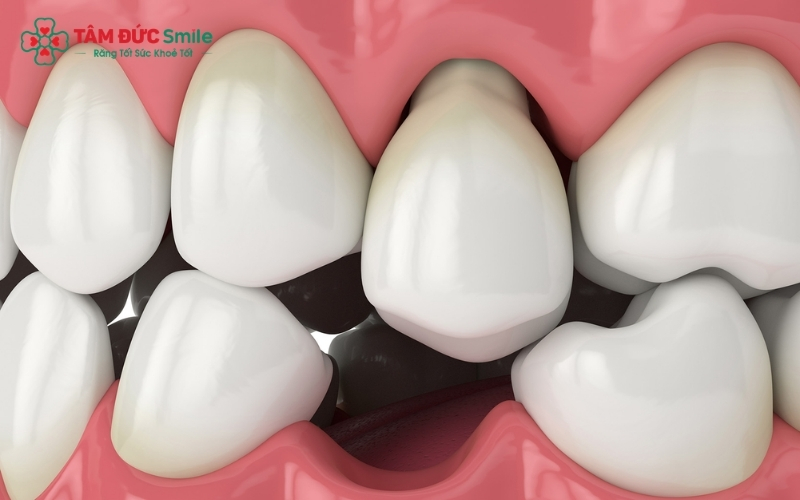 Đau nướu kéo dài nếu không điều trị sớm có thể tiến triển thành viêm nha chu, gây tiêu xương và lung lay răng.