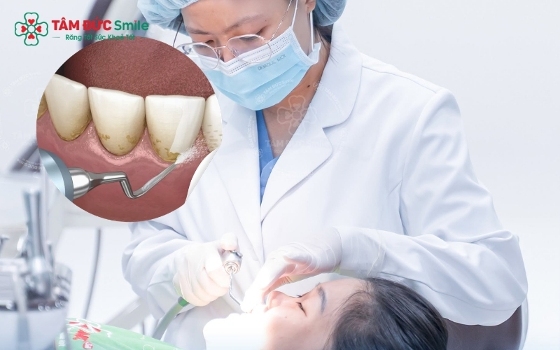 Cạo vôi răng định kỳ là "chìa khóa" giúp bạn sở hữu nướu khỏe, răng bền.