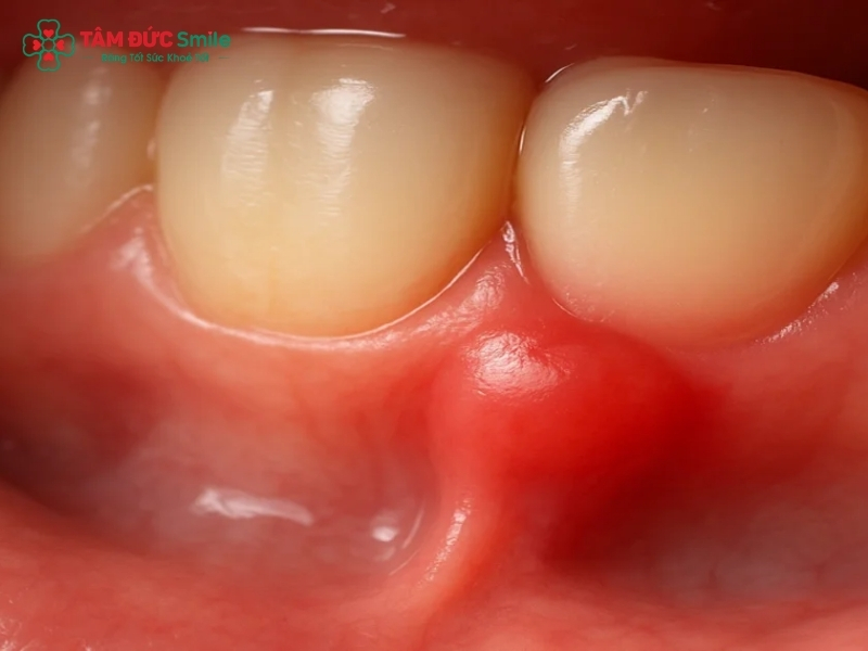 Đau nướu răng: Nguyên nhân, tác hại và cách điều trị hiệu quả