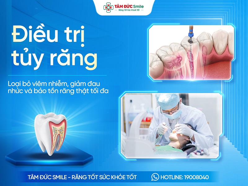 Điều trị tủy răng là gì? Quy trình, Chi phí và Khi nào cần thực hiện