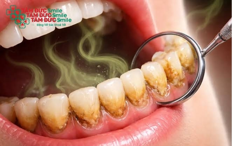 Xác định đúng nguyên nhân gốc rễ là chìa khóa để điều trị dứt điểm tình trạng hôi miệng.