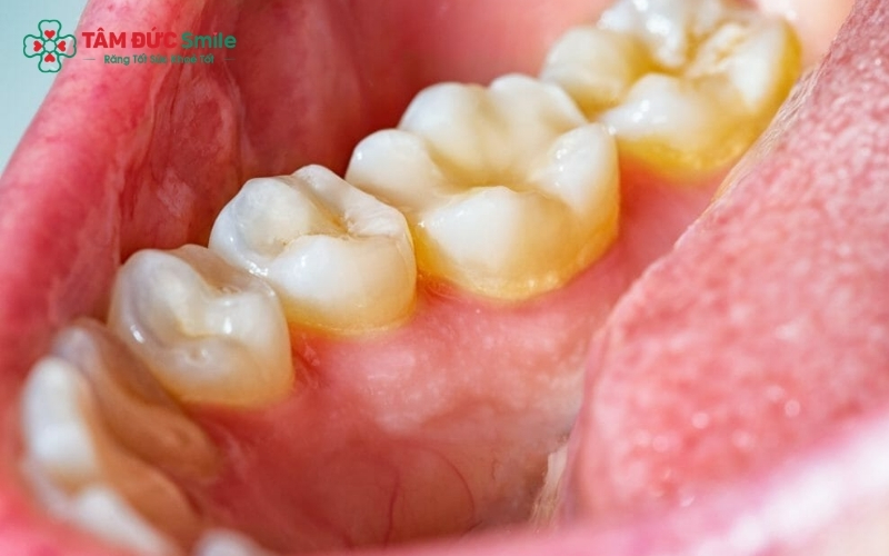 Mảng bám và cao răng là "thủ phạm" hàng đầu khiến hơi thở có mùi khó chịu.