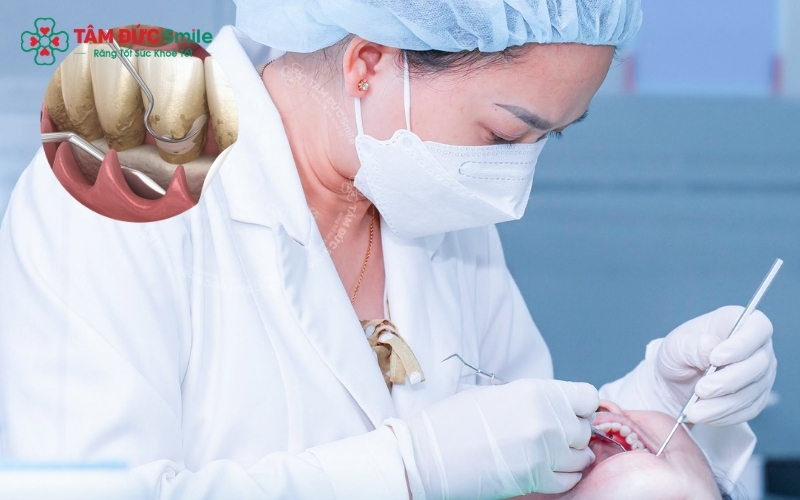 Cạo vôi răng định kỳ là cách nhanh nhất và hiệu quả nhất để loại bỏ nguồn gốc gây mùi trong khoang miệng.