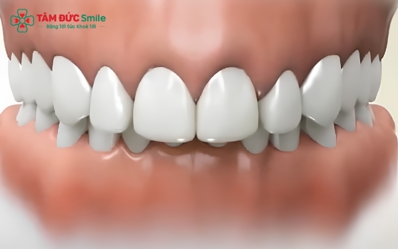 Khớp cắn sâu là tình trạng răng hàm trên che phủ quá mức răng hàm dưới, gây mất cân đối nụ cười.
