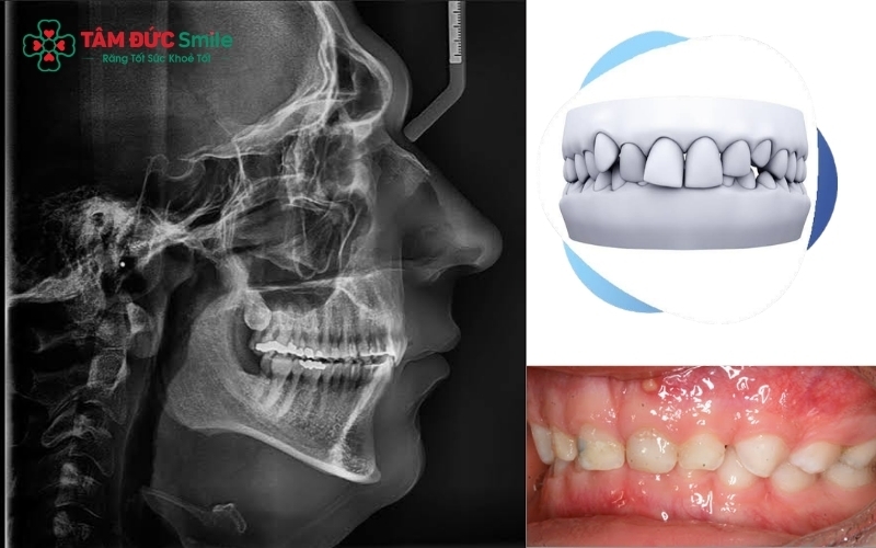 Bác sĩ kiểm tra phim X-quang để xác định chính xác nguyên nhân cắn sâu do răng hay do cấu trúc xương hàm.