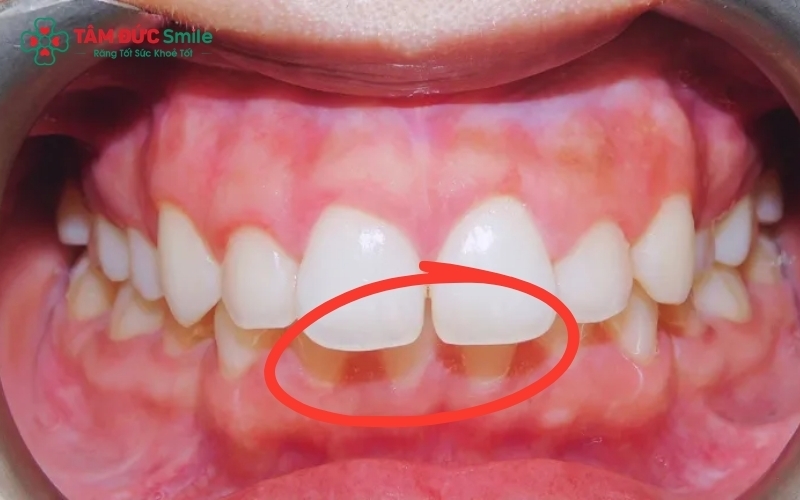 Khớp cắn sâu lâu ngày dễ dẫn đến tình trạng mòn răng, ê buốt và tổn thương mô nướu vùng khẩu cái.