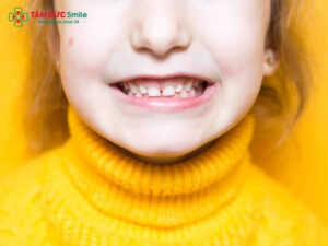 Khớp cắn sâu là gì? Nguyên nhân, tác hại và cách điều trị hiệu quả