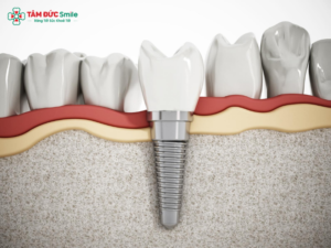 ky-thuat-phuc-hinh-rang-hien-dai-phuc-hinh-co-dinh-implant-rang-su-tham-my-1
