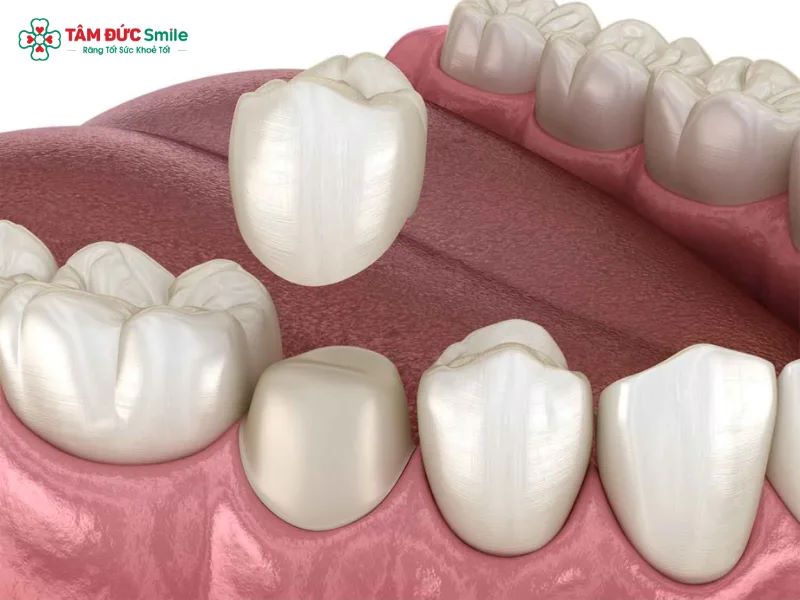 Bọc răng sứ giúp phục hồi hình dáng, chức năng ăn nhai và thẩm mỹ cho răng hư tổn tại Nha khoa Tâm Đức Smile.