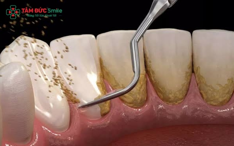 Lấy cao răng định kỳ không chỉ giúp hơi thở thơm mát mà còn bảo vệ nướu răng khỏi các tác nhân gây viêm nhiễm.