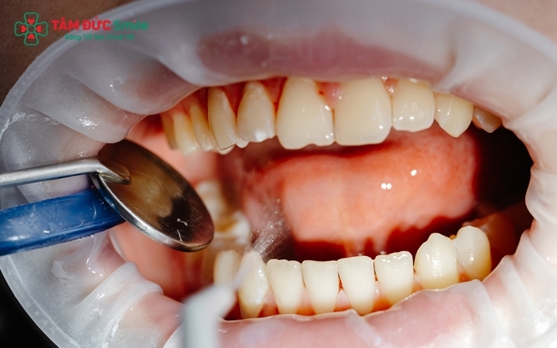 Bác sĩ tại Nha khoa Tâm Đức Smile sẽ kiểm tra và tư vấn tần suất lấy cao răng phù hợp (3-6 tháng/lần) dựa trên tình trạng răng miệng thực tế của bạn.