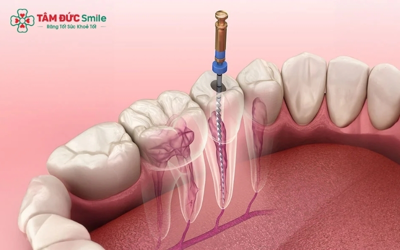 Quy trình lấy tủy giúp loại bỏ ổ nhiễm khuẩn, bảo tồn chân răng thật vững chắc