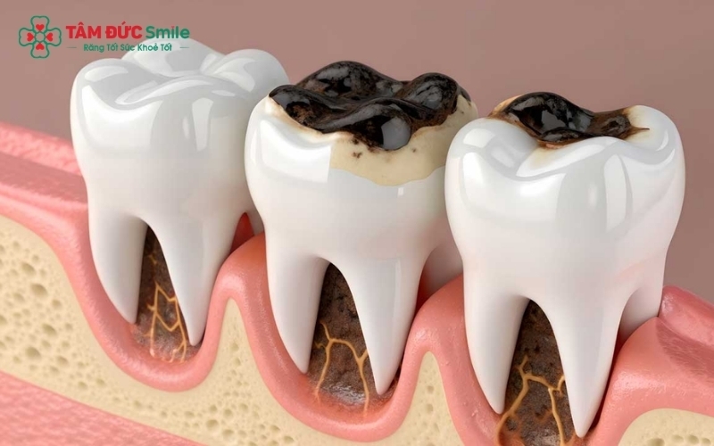 Khi sâu răng tiến triển vào đến buồng tủy, việc điều trị tủy sớm là "chìa khóa" để cứu vãn chiếc răng.