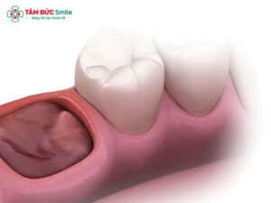 Lưu ý sau khi nhổ răng khôn: Cách chăm sóc, ăn uống và vệ sinh
