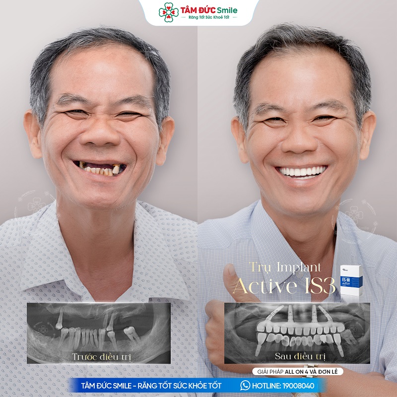 Cấy ghép Implant toàn hàm All-on-4/All-on-6 giúp phục hồi khả năng ăn nhai và tăng độ ổn định cho hàm răng.